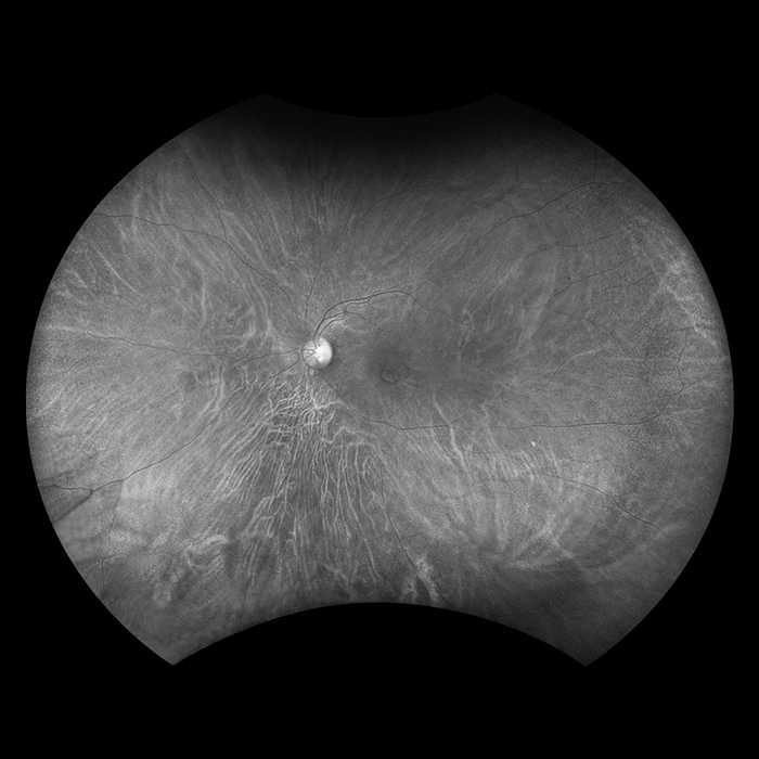 Silverstone optomap Choroidal