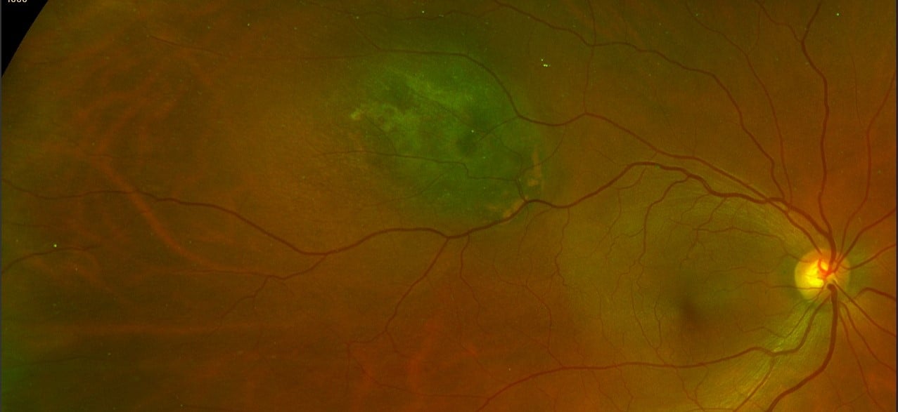 choroidal melanoma