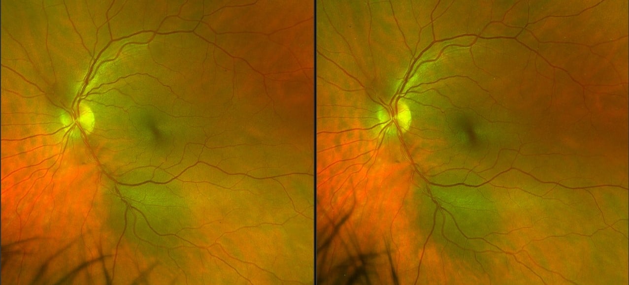 large choroidal nevus