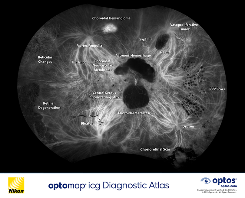 optomap icg diagnostic atlas