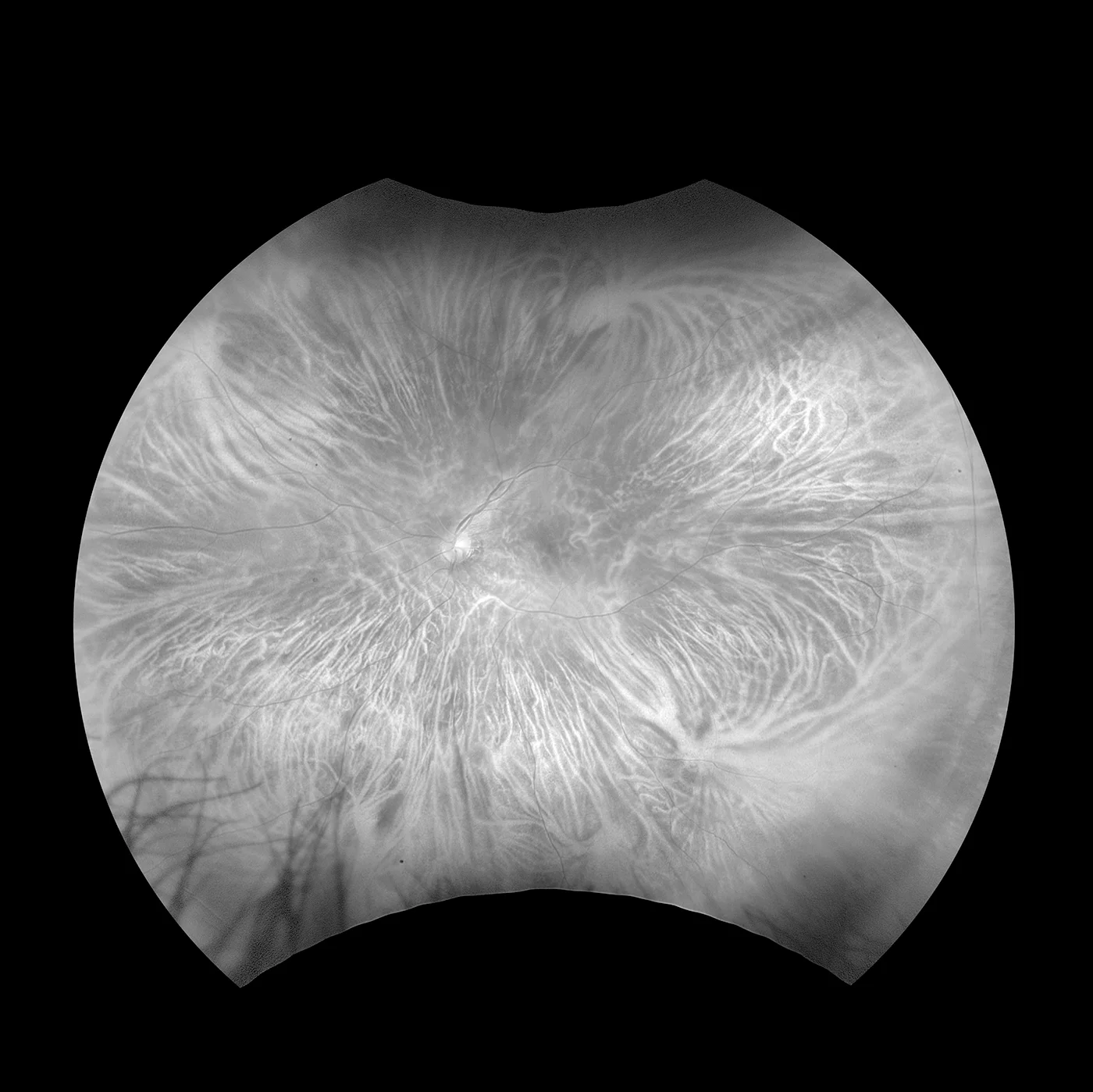 choroidal